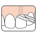 TePe Bridge & Implant Floss | 30 stuks
