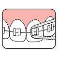TePe Bridge & Implant Floss | 30 stuks