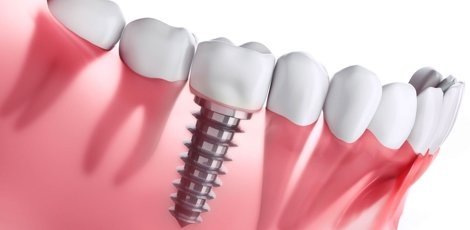 Implantaten