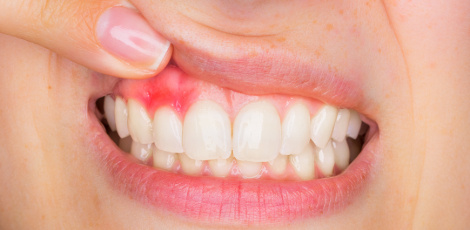 Tandvleesontsteking – Hoe herken en behandel je ontstoken tandvlees?