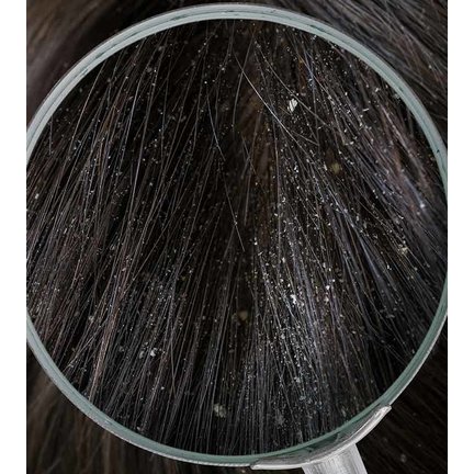 Hair care againts Dandruff and Flakes