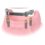 OSSTEM Convertible
