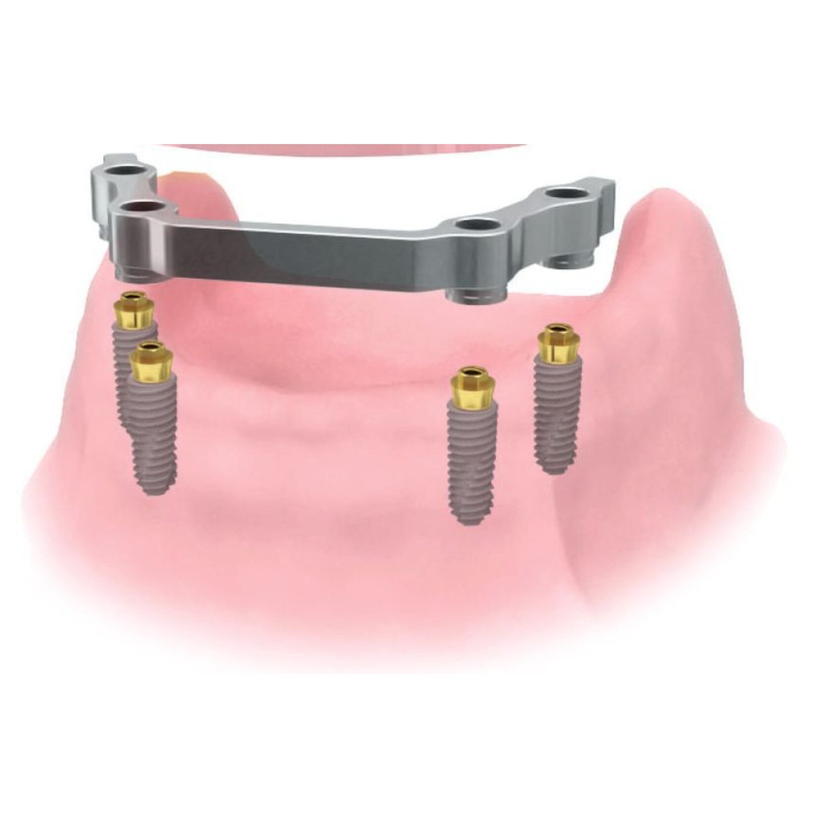 OSSTEM Convertible