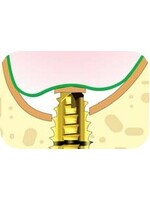 Cowellmedi Sinus Lift  Kit