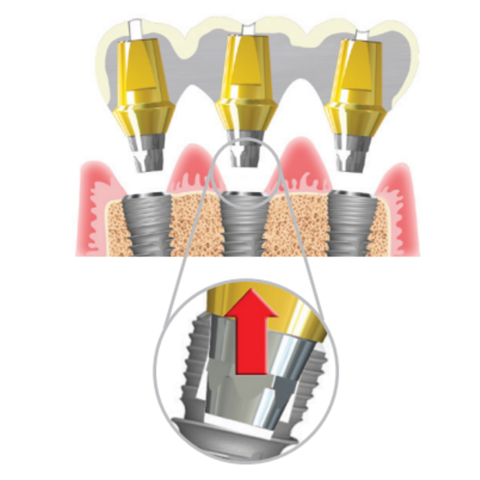 NeoBiotech Zementiertes Abutment Neobiotech