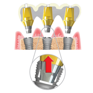 NeoBiotech Cemented Abutment Neobiotech