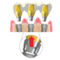 NeoBiotech Cemented Abutment Neobiotech