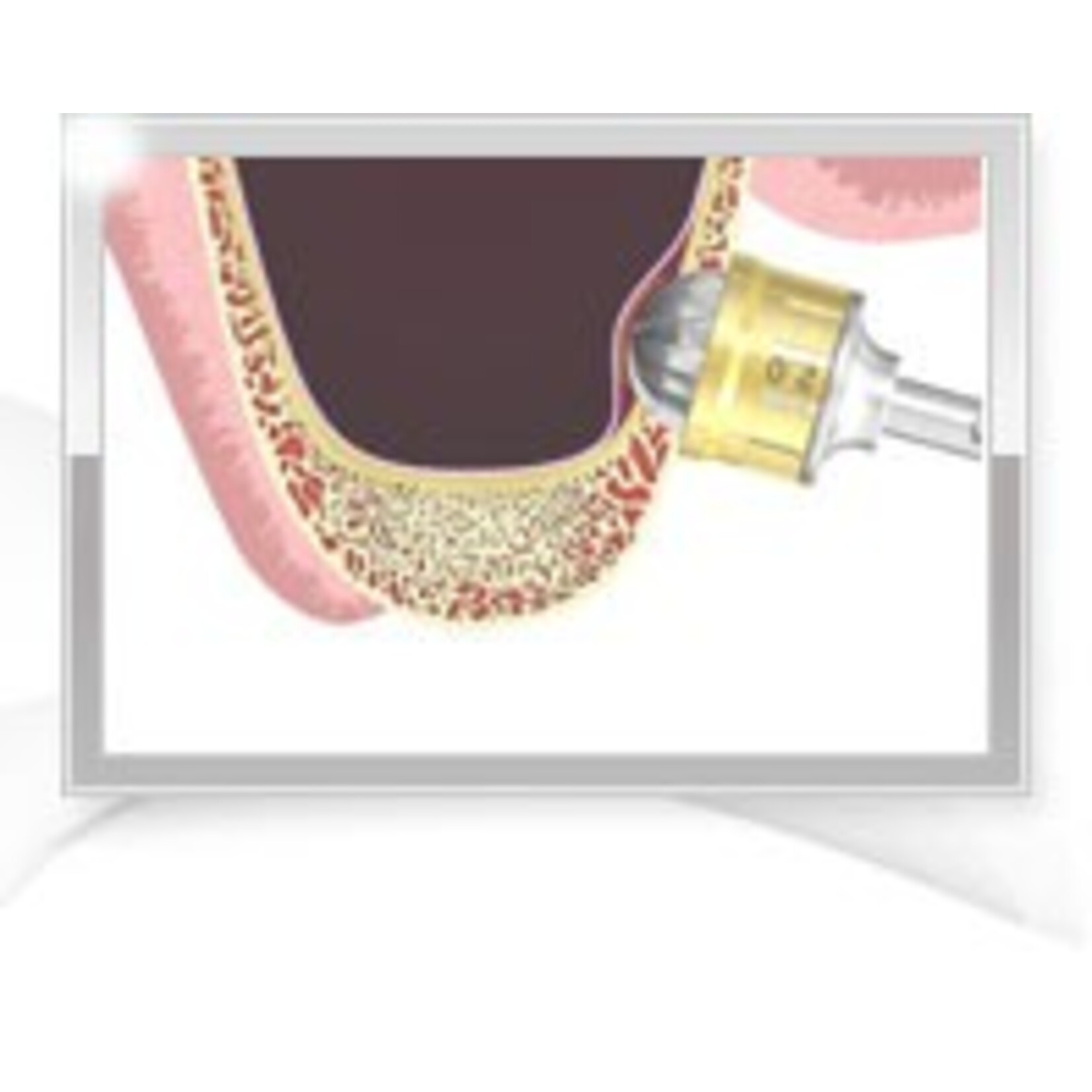 OSSTEM HIOSSEN 's Lateral Approach Sinus - Kit, LAS-KIT, Las Kit