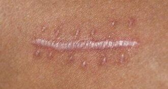 Piercing door litteken: kan dat, hoe lang wachten en wat met buikcorrecties? | Expert Gids