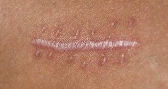 Piercing door litteken: kan dat, hoe lang wachten en wat met buikcorrecties? | Expert Gids