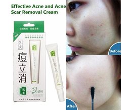 Akne-Behandlung-Creme Akne-Behandlung-Creme