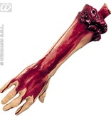 Afgehakte arm
