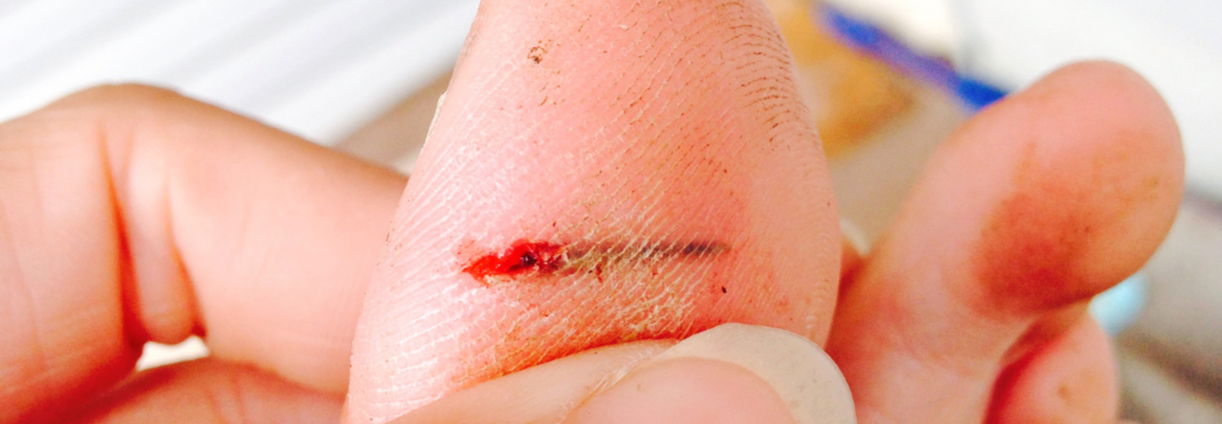 Splinter verwijderen? Volg onze tips! | Apotheek&Huid - Apotheek en huid