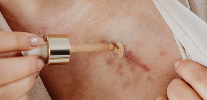 tips om littekens minder zichtbaar te maken - Apotheek en huid - Apotheek huid