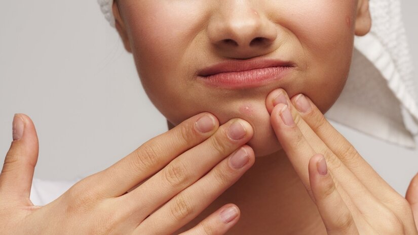 Wat is acne en wat kan ik er tegen doen?