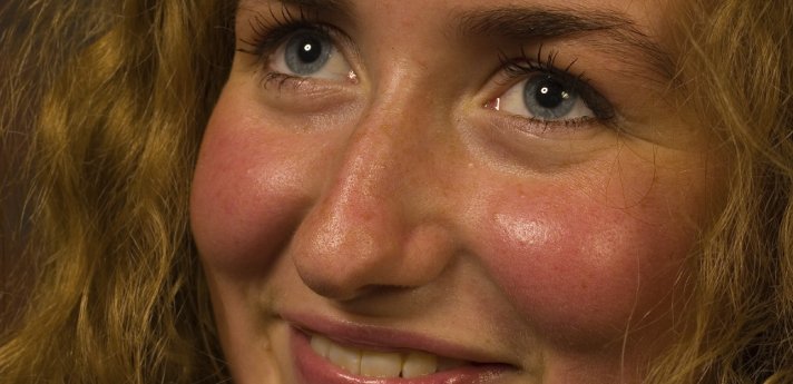 Voorkomen en behandelen van een rode huid