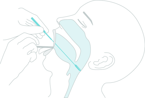 Nadal Covid 19 Antigen Schnelltest 20 Corona Tests Nasal Medizinischer Fachhandel