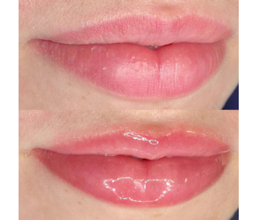 COLLAGEEN LIP PLUMP TREATMENTS