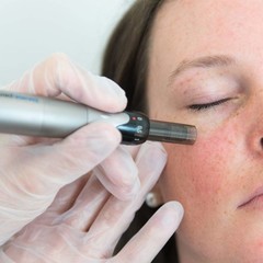 Dermapen4 Microneedling vanaf
