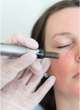Dermapen4 Microneedling vanaf
