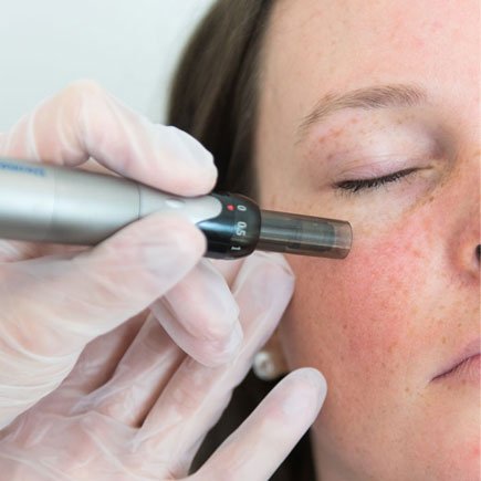 Microneedling