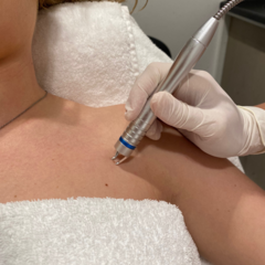 Laserbehandeling Rosacea, Couperose en Roodheden