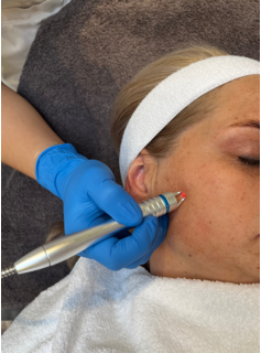 Laserbehandeling Pigment