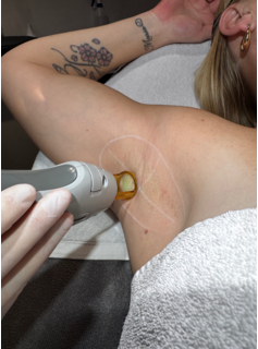 Laserbehandeling Definitief ontharen vanaf