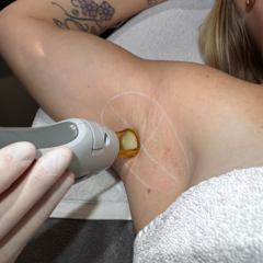 Laserbehandeling Definitief ontharen vanaf
