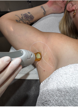 Laserbehandeling Definitief ontharen vanaf