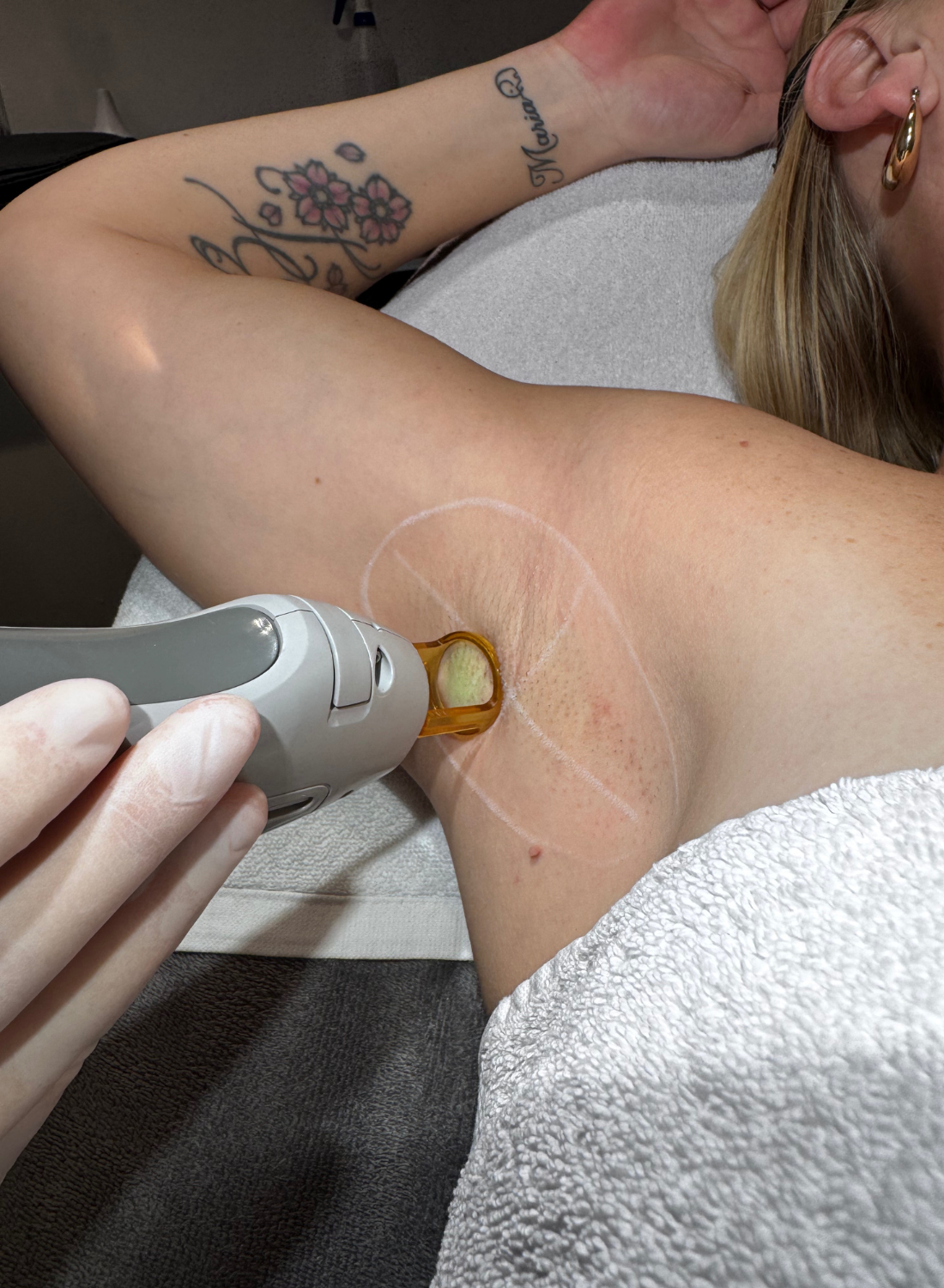 Laserbehandeling                  (ontharen, pigment en vaatafwijkingen)