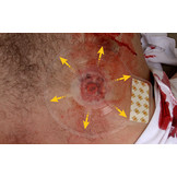 Twin Pack Chest Seal