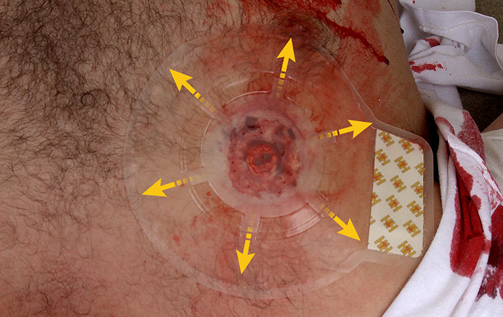 Twin Pack Chest Seal