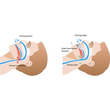 SleepPro Anti Snurkbeugel Contour SFA Verstelbaar - 7 standen