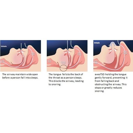 aveoTSD Tongstabilisator tegen snurken en apneu