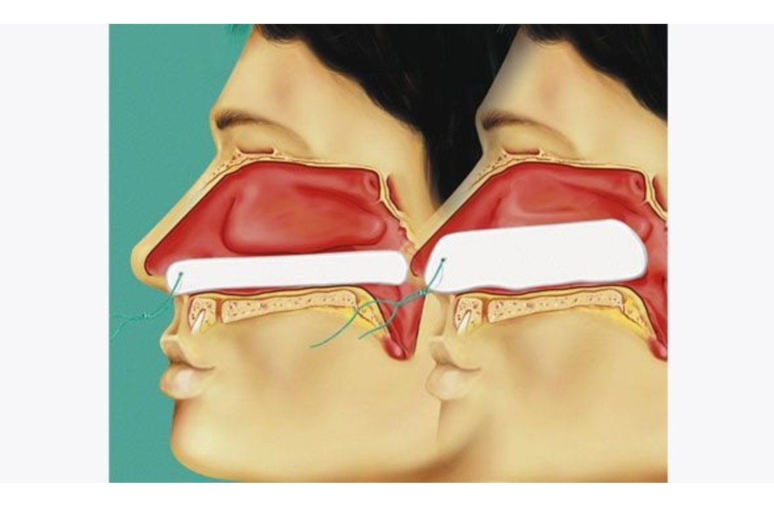 Raucocel neustampon epistaxis 10 cm (10 stuks)