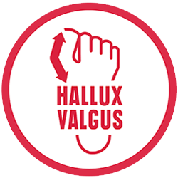 hallux valgus