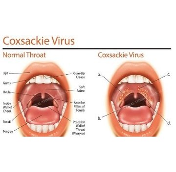 coxsackievirus