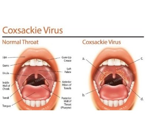 coxsackievirus
