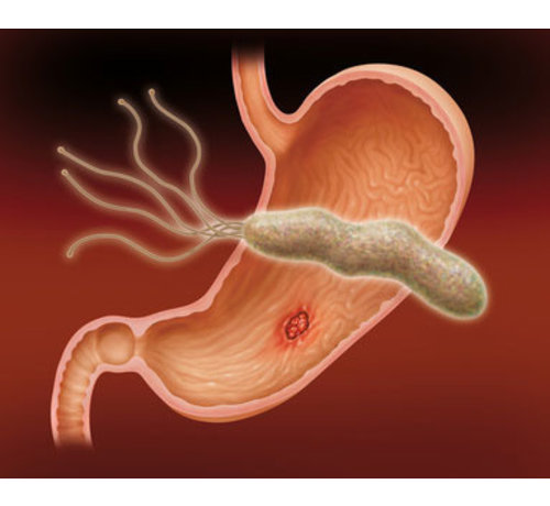 Helicobacter Pylori stomach pain