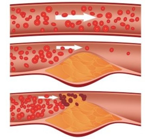 Fat Profile Plus: Total Cholesterol, HDL, LDL, Triglycerides and VLDL