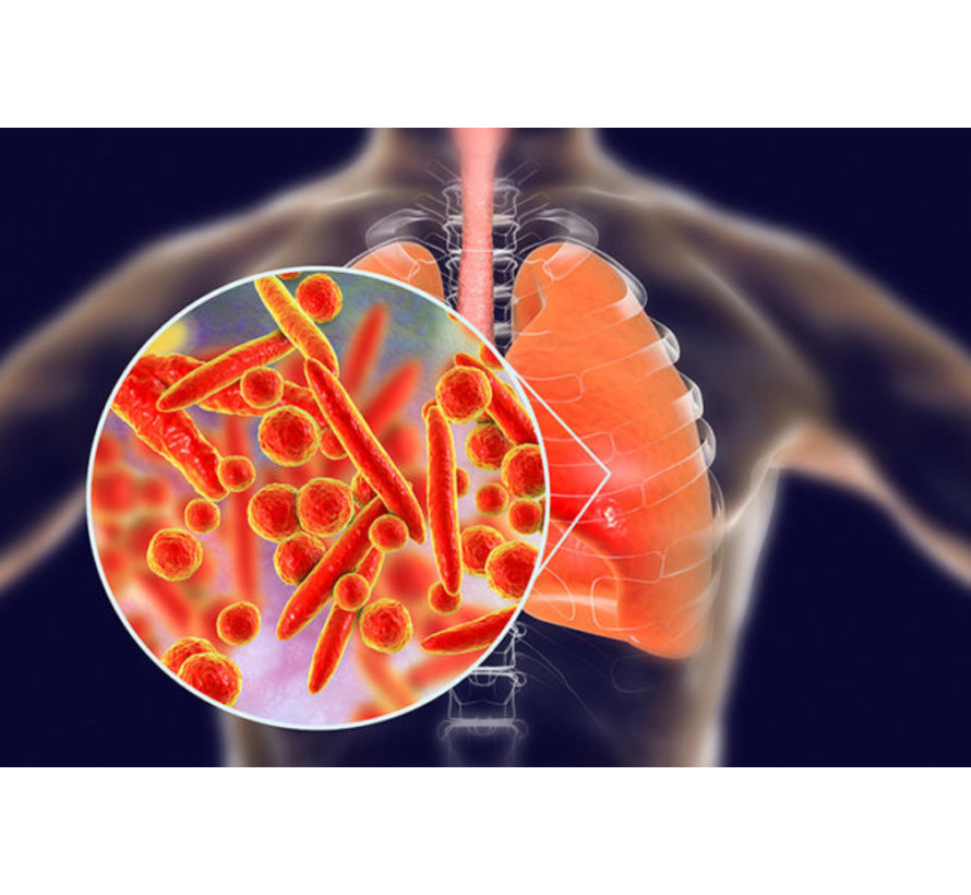 Mycoplasma pneumoniae bacterie longontsteking