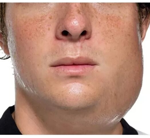 Bof virus IgM en  IgG (parotitis)