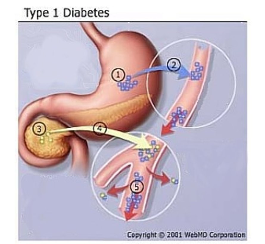 Insulin Diabetes