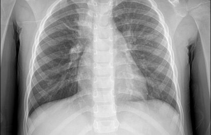 Mycoplasma Pneumoniae and Pneumonia: Testing and Diagnosis