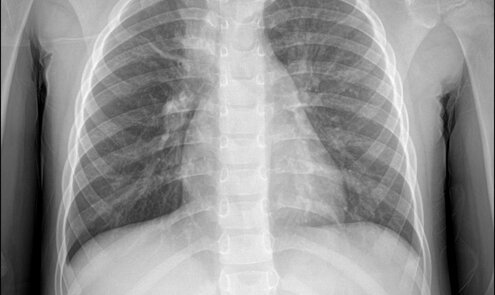 Mycoplasma pneumoniae and Pneumonia: Testing and Diagnosis