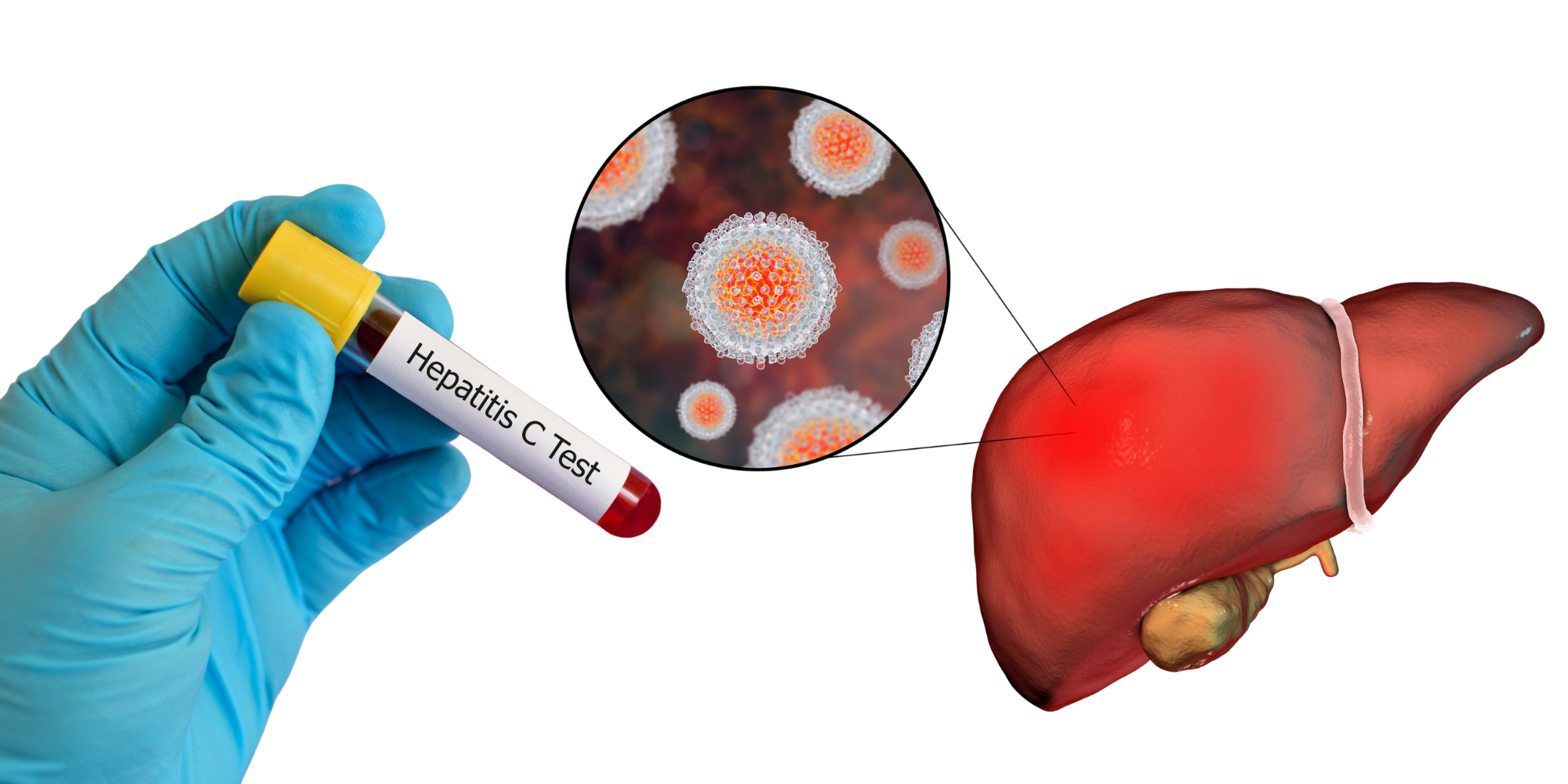 Wat is Hepatitis C, hoe krijg je het en hoe kun je het testen