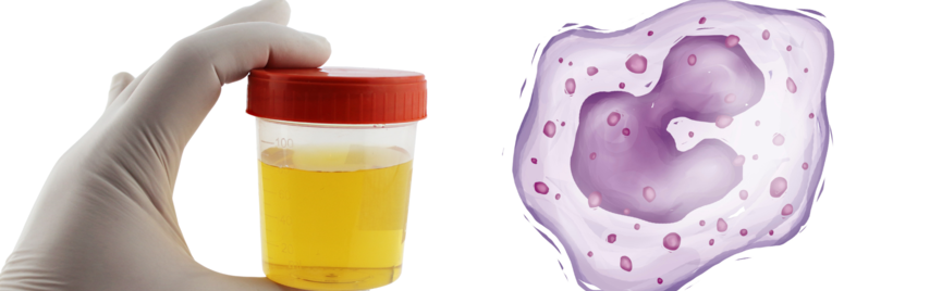 Wat is de normaalwaarde van leukocyten in urine?