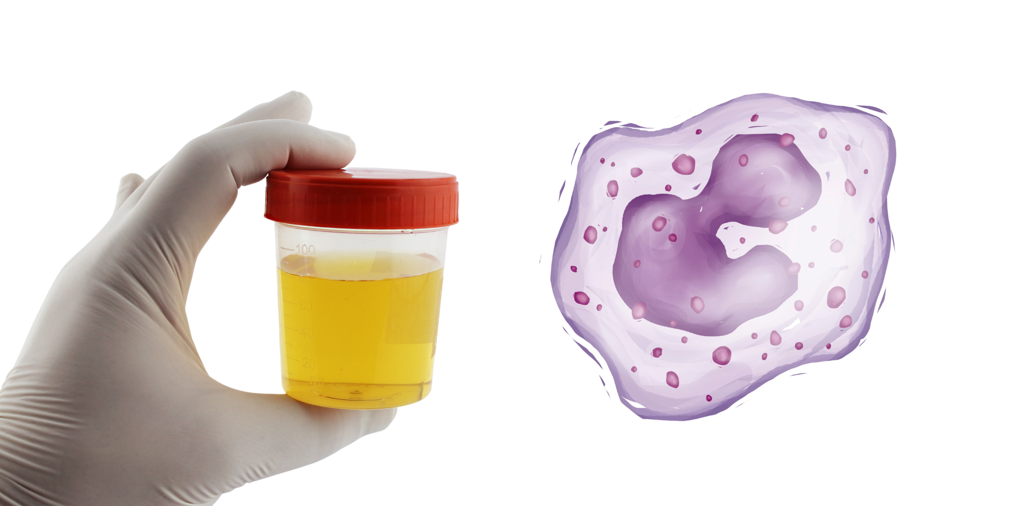 Te veel witte bloedcellen (leukocytose)
