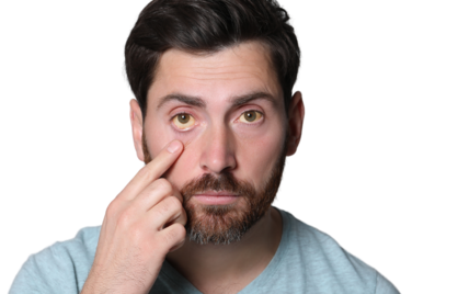 Gele Ogen? Wat Bilirubine  vertelt Over Je Gezondheid